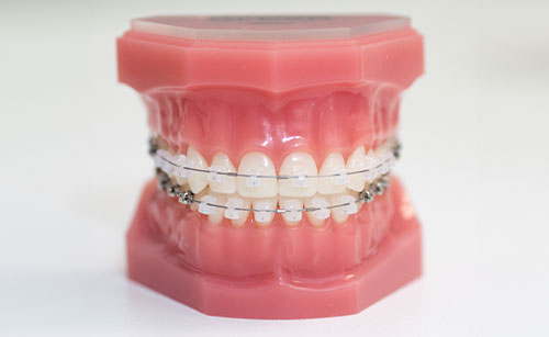Ceramic Braces